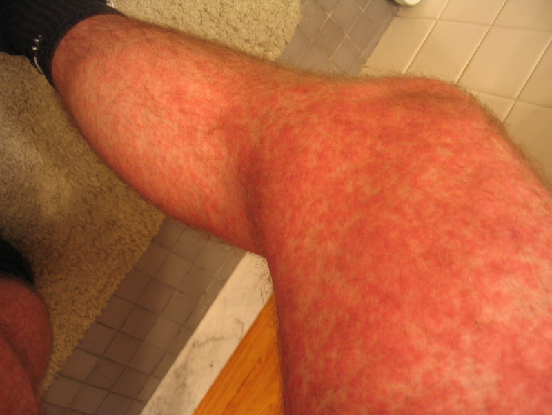 allergic reaction rash. rash 04 060604.jpg